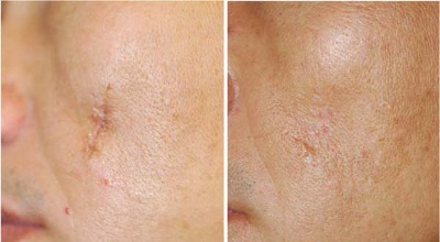 Шрам на лице до и после лечения гелем Дерматикс