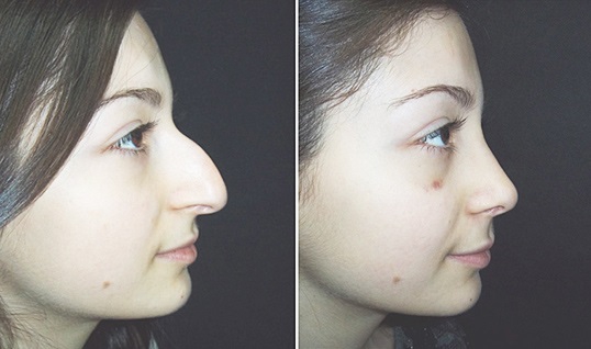 Девушка с горбинкой на носу: фото до и после ринопластики