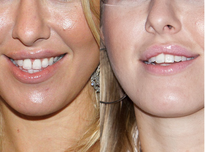 Ксения Собчак: фото до и после контурной пластики губ
