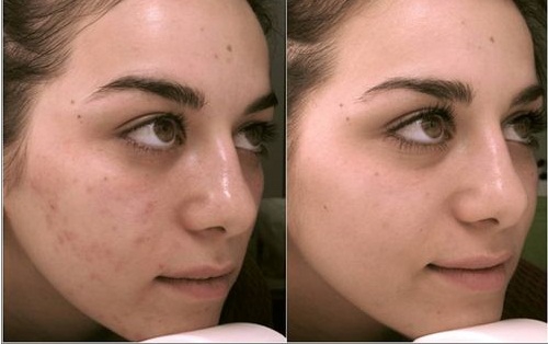 Пилинг лица Дифферином: фото до и после процедуры