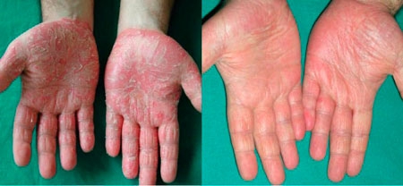 Пилинг рыбками кожи рук: фото до и после процедуры