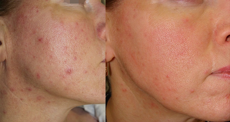 Дезинкрустация пористой угреватой кожи лица: до и после процедуры