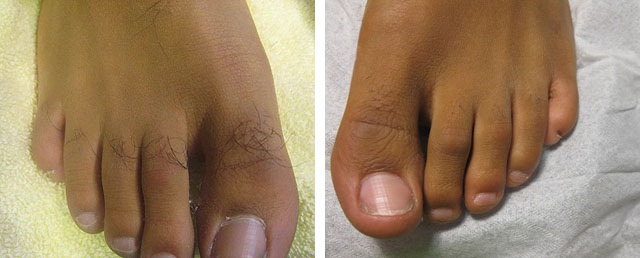 Пальцы ног до и после Кул-эпиляции