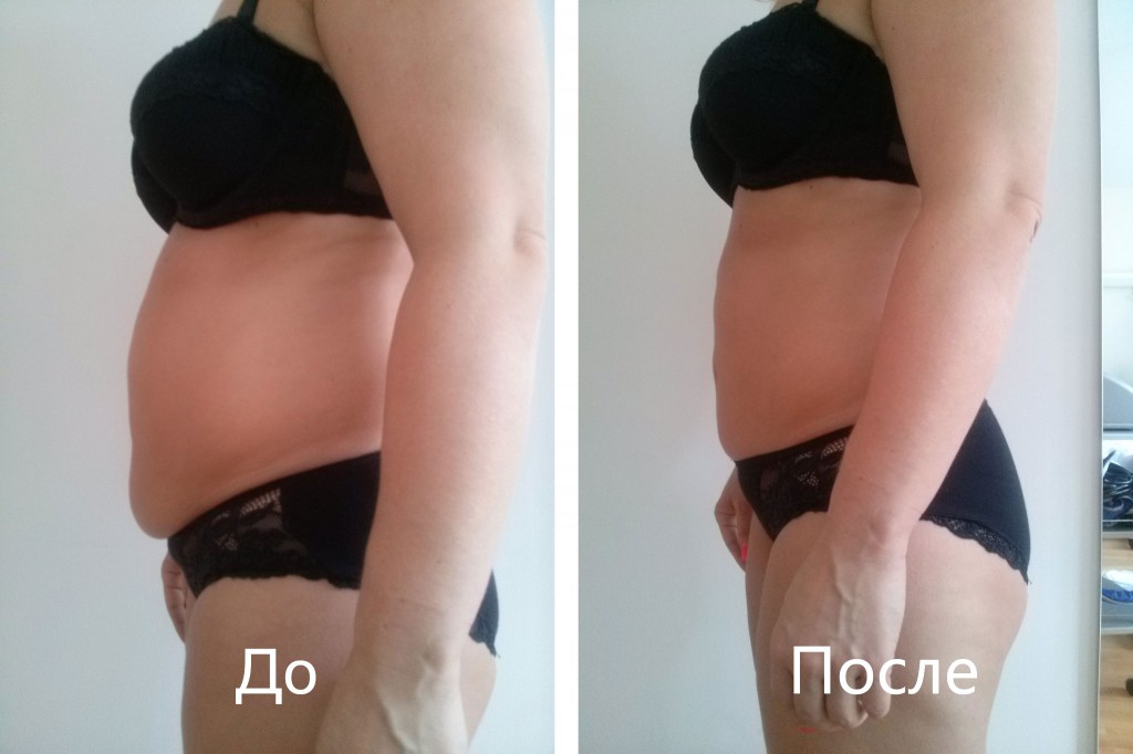 Кавитация: фото до и после процедуры уменьшения жировой прослойки
