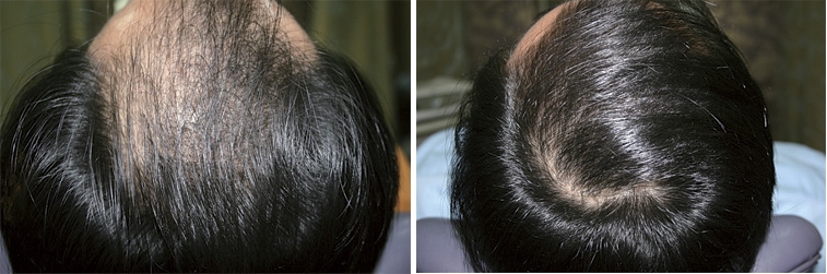 Бустер Дермахил для волос. Фото до и после