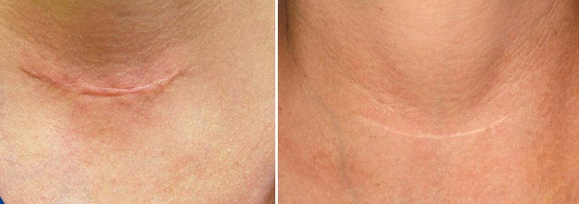 Шрам на шее до и после лечения гелем Дерматикс