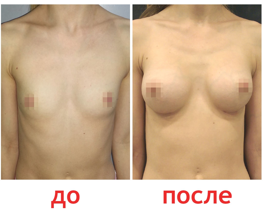 Увеличение груди с помощью имплантов