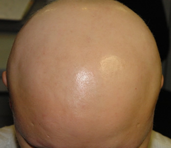 Тотальная алопеция (полная потеря волос на голове)