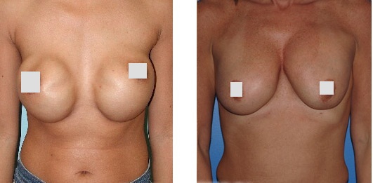 Асимметрия груди может быть следствием смещения имплантов
