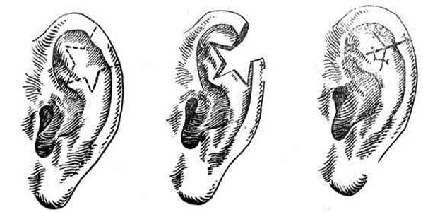 Операционное уменьшение большого уха с иссечением лоскута тканей сложной формы