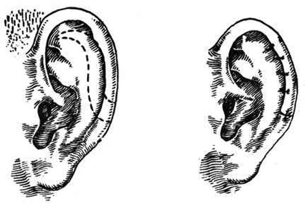 Схема коррекции большого уха посредством удаления части хряща под завитком