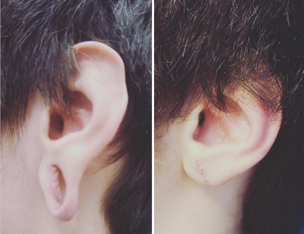 Большая мочка уха может быть последствием ношения «тоннелей»