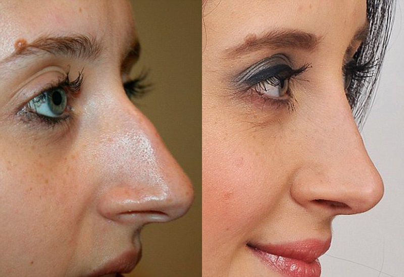 Девушка с большим носом фото до и после коррекции