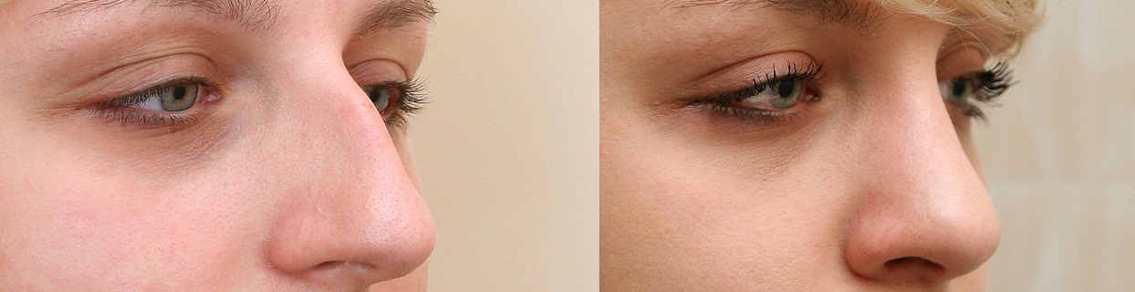 Женщина с большим носом фото до и после ринопластики