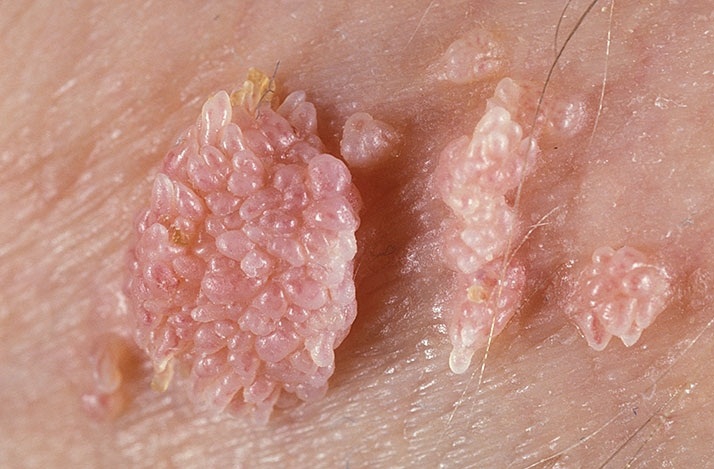 Остроконечные кондиломы – это образования, состоящие из мелких розовых узелков