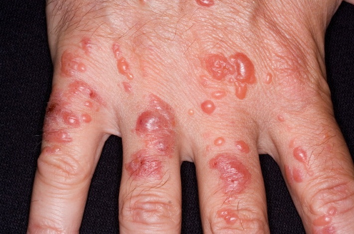 Буллёзный дерматит: аллергический контактный дерматит на руках