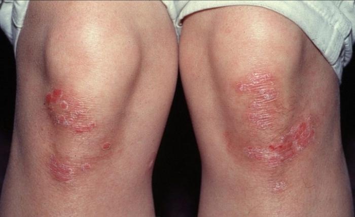 Чешуйчатый лишай часто располагается в зонах коленных суставов