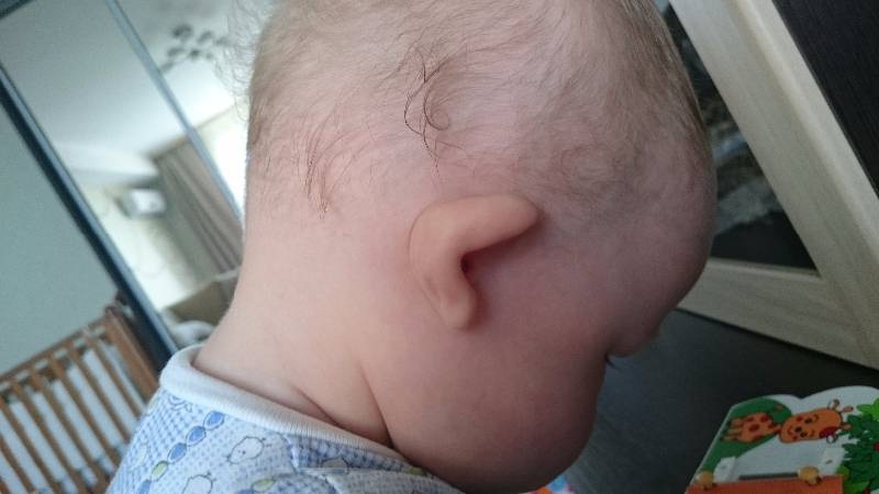 Наследственная деформация ушной раковины у ребенка