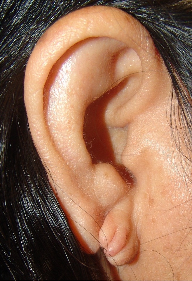 Деформация ушной раковины проявляется в необычной форме мочки уха