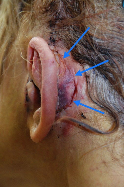 Фото после отопластики – в ходе операции была исправлена врожденная деформация ушной раковины