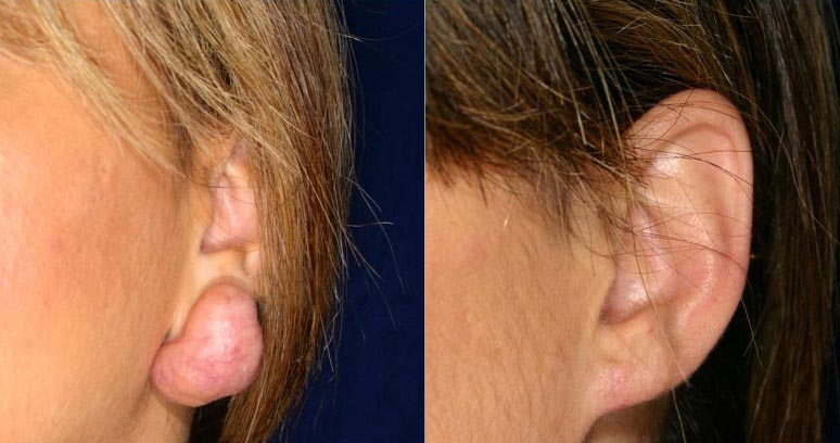 Устранение келоидного рубца мочки уха – фото до и после лечения деформации ушной раковины