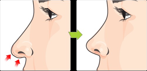 Если нос длинный, то укорачивают кончик носа