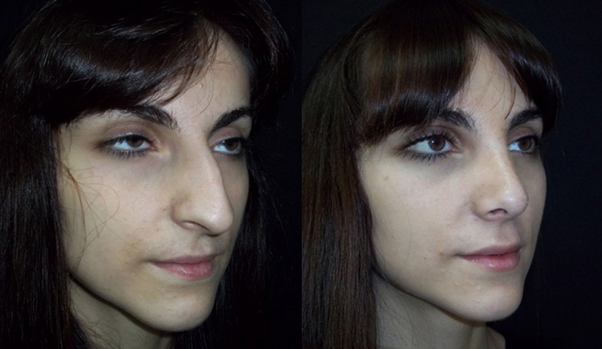 Длинный нос: фото девушки до и после операции