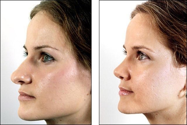 Длинный нос: фото женщины до и после операции