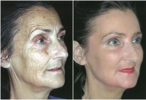 Дряблая кожа лица: фото до и после дарсонвализации