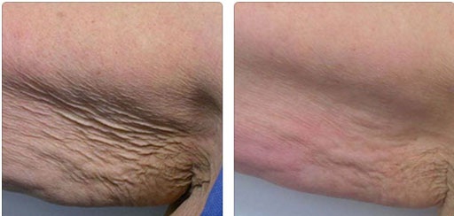 Дряблая кожа рук: фото до и после ультразвукового лифтинга