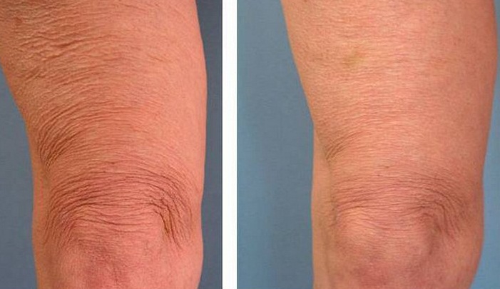 Дряблая кожа ног: фото до и после ультразвукового лифтинга