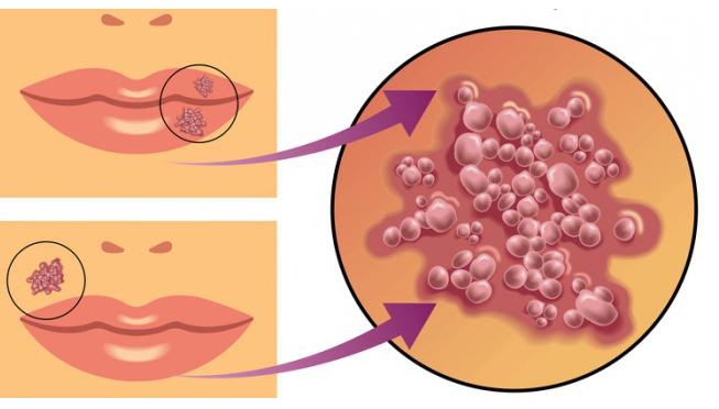 Герпетический дерматит: одно из самых распространенных проявлений – «простуда на губах»