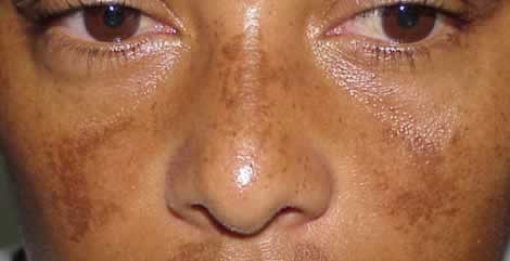 Гиперпигментация типа мелазмы на лице