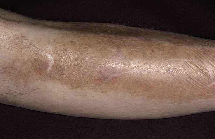 Поствоспалительная пигментация (мелазма) кожи ног