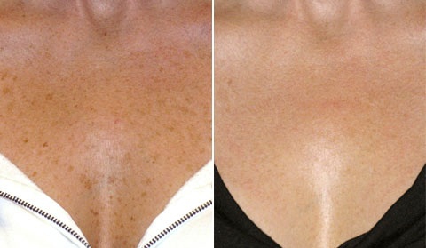 Фото до и после лечения гиперпигментации кожи груди