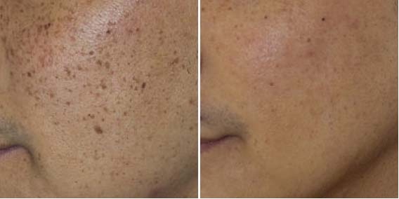 Фото до и после лечения гиперпигментации кожи лица (щеки)