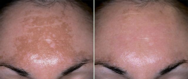 Фото до и после лечения гиперпигментации кожи лица (лоб)