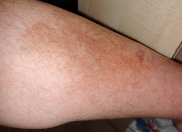 Гиперпигментация кожи ног (голени)