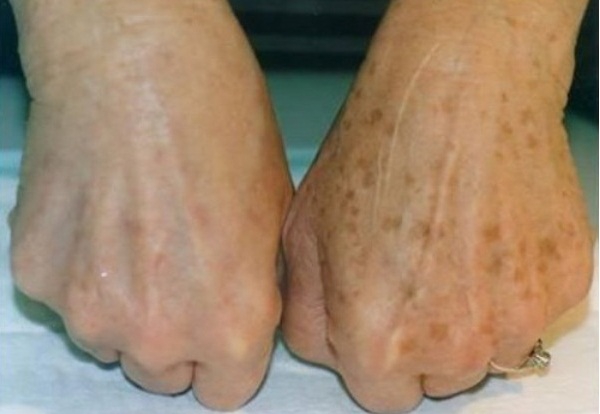 Фото до и после лечения гиперпигментации кожи рук