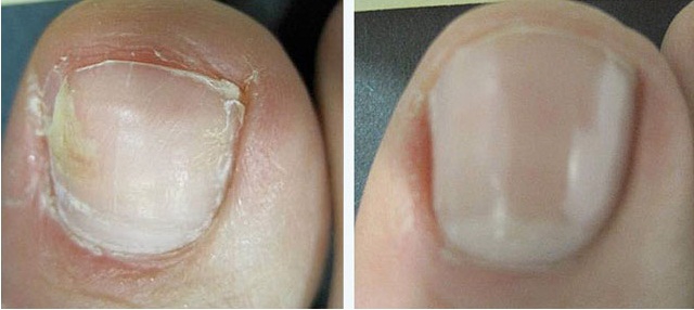 Результат лечения грибка ногтей лазером