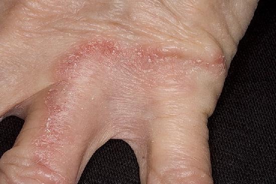 Грибок кожи рук (дерматофития)