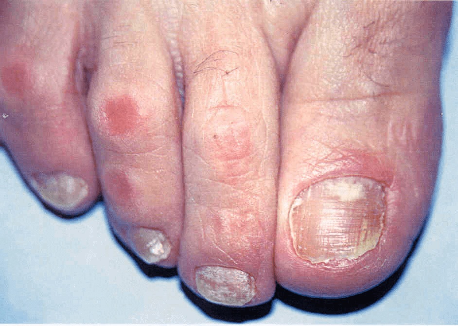 Третья стадия поражения ногтей грибковой инфекцией