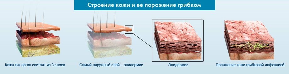 Как меняется структура кожи при поражении грибком