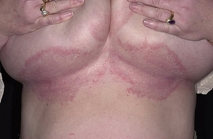 Опрелость (интертригинозный дерматит) под грудью
