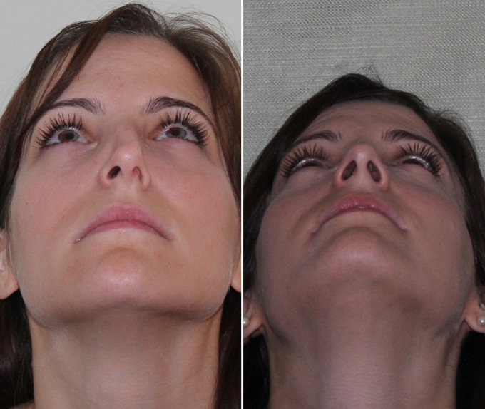 После хирургического лечения искривления перегородки носа пациентка стала нормально дышать