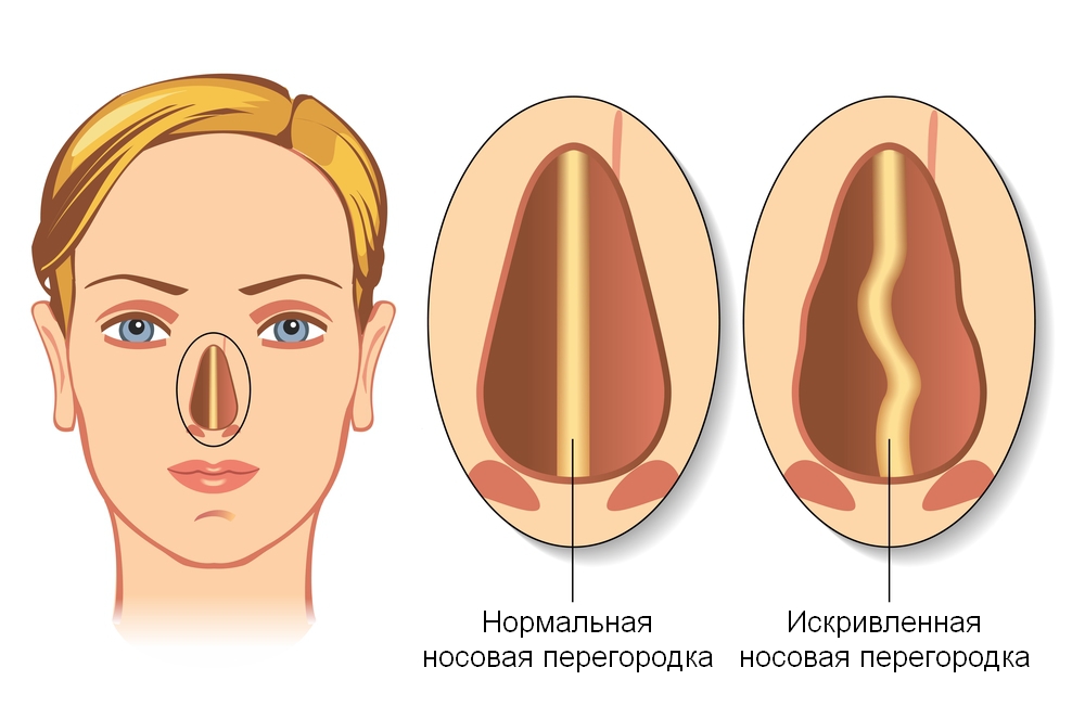 Как выглядит искривленная перегородка носа до и после операции