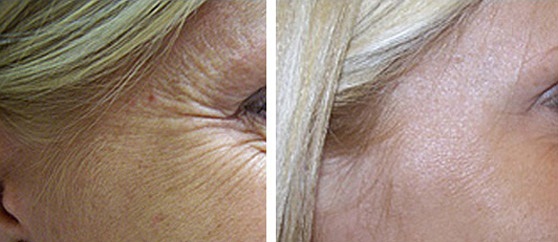 Фото до и после коррекции морщин под глазами (гусиные лапки)