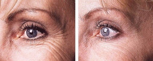 Фото до и после коррекции морщин под глазами
