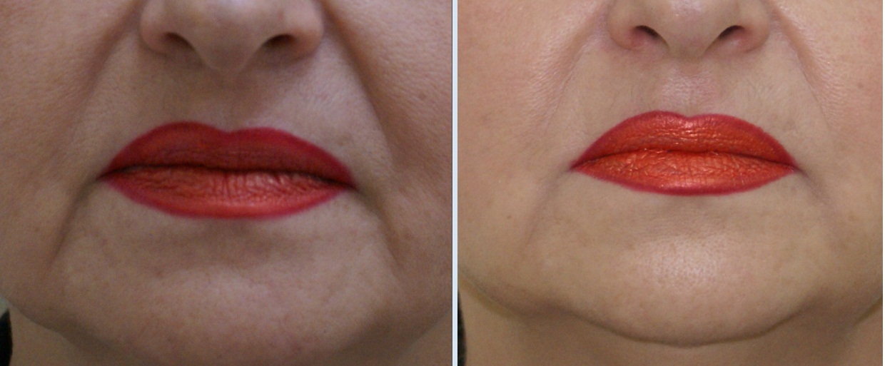Морщины вокруг губ: фото до и после коррекции морщин марионеток