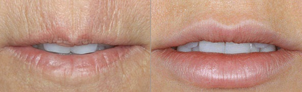 Морщины вокруг губ: фото до и после коррекции кисетных морщин